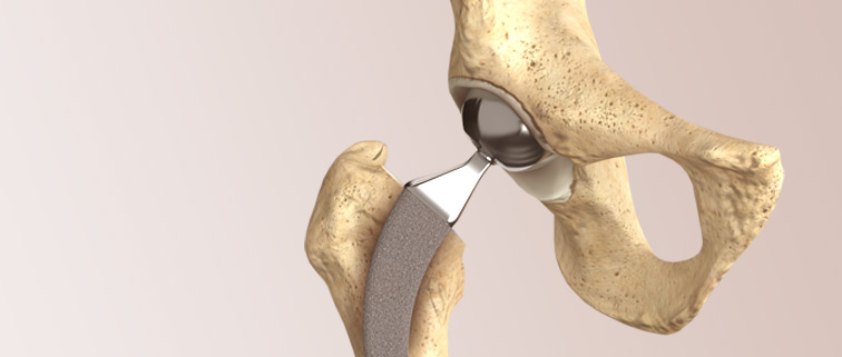 Joint Replacement FAQ’s